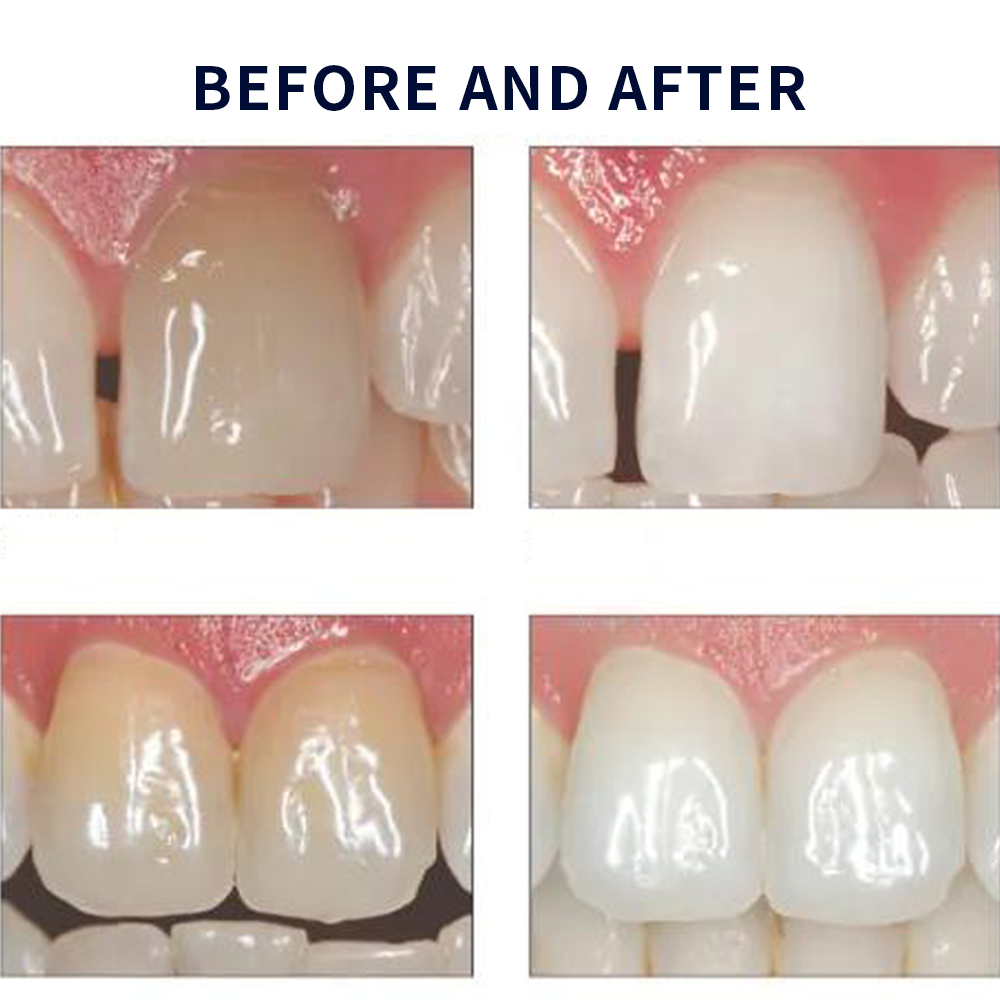 Opalescence Whitening 20% PF 2 – Teeth Whitening Hydrogen Peroxide recenzja i cena