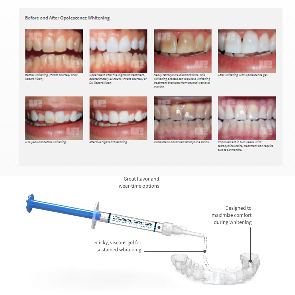 Opalescence Whitening 20% PF 2 – Teeth Whitening Hydrogen Peroxide recenzja i cena