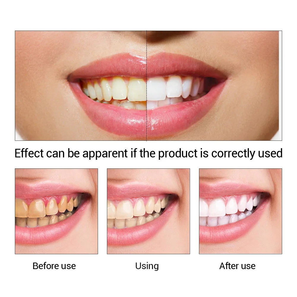 FTEENPLY esencja do wybielania – Teeth Whitening Procedure recenzja i cena