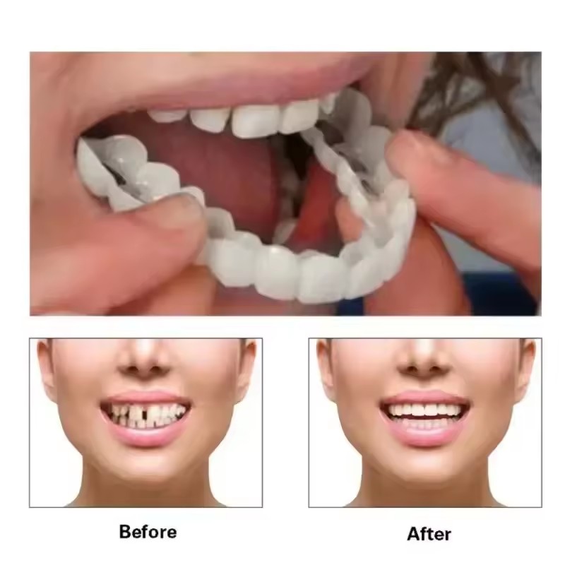 Okładziny na zęby Wybielanie z – Teeth Whitening Procedure recenzja i cena