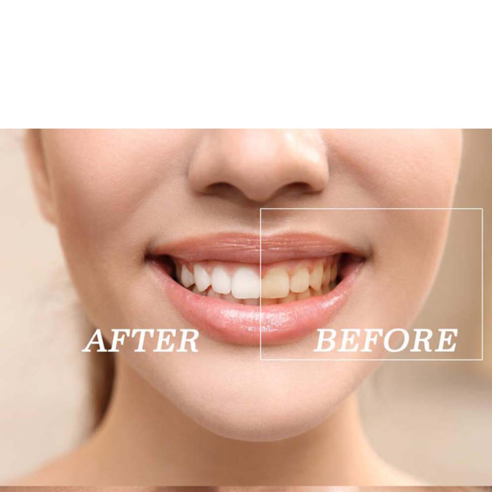 Najwyższej jakości zestaw żelo – Teeth Whitening/Bleaching recenzja i cena